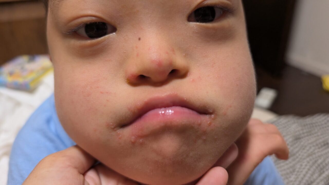 夏休み4日目　発熱後 手足口病で病院受診